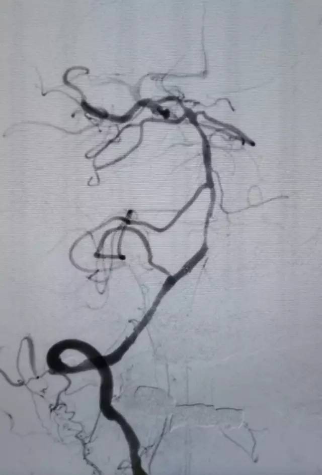 基底动脉狭窄介入治疗的病例分享,天坛医院颈动脉闭塞的介入治疗