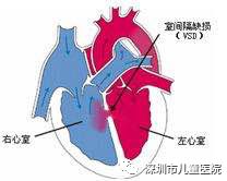 全球首款！深儿医参与研发这把“伞”，“补心”不留痕迹