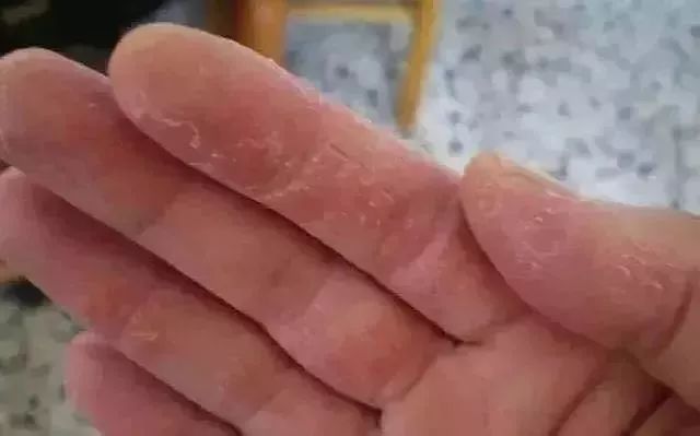 手足脱皮脚后跟干裂修复膏,奇迹第十代