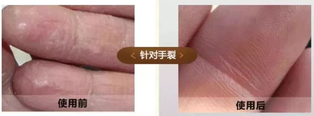 手足脱皮脚后跟干裂修复膏,奇迹第十代