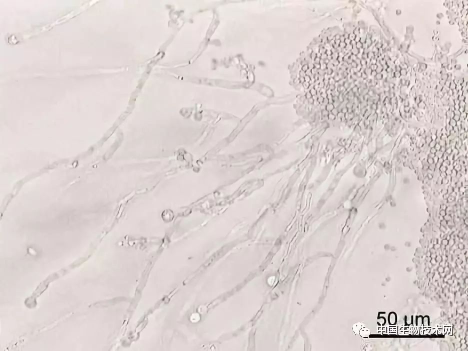 真菌感染会导致哪些疾病,真菌感染会引起癫痫吗