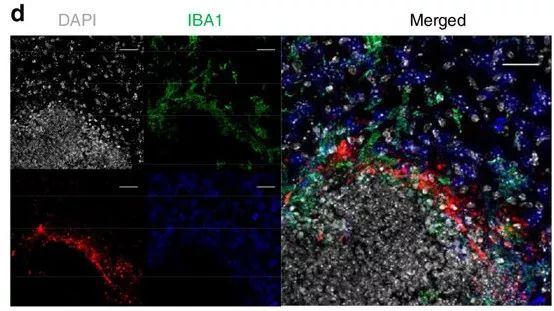 真菌感染会导致哪些疾病,真菌感染会引起癫痫吗