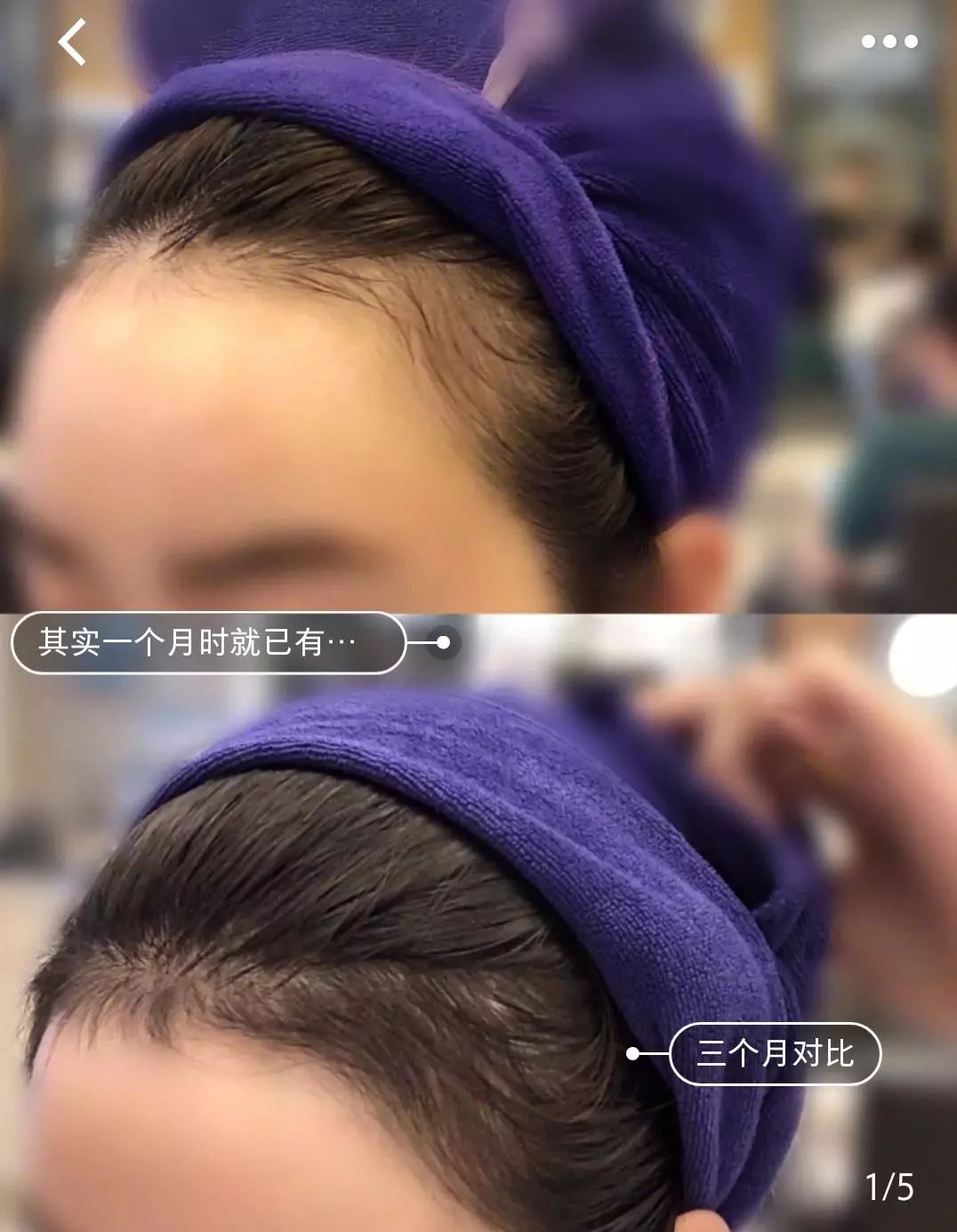 一把梳子拯救你的发际线,拯救发际线神器梳子