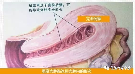通经汤治疗闭经,闭经的中医治疗