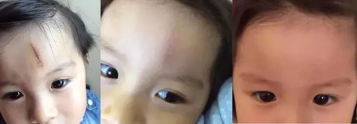 疤痕彻底消失新技术,疤痕淡化修复新技术