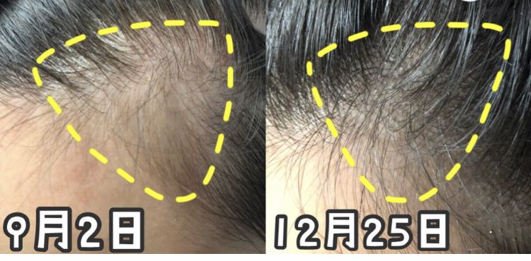 疯狂掉头发发际线后移,疯狂掉头发头发变得稀疏