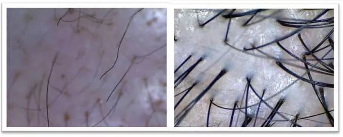 疯狂掉头发发际线后移,疯狂掉头发头发变得稀疏