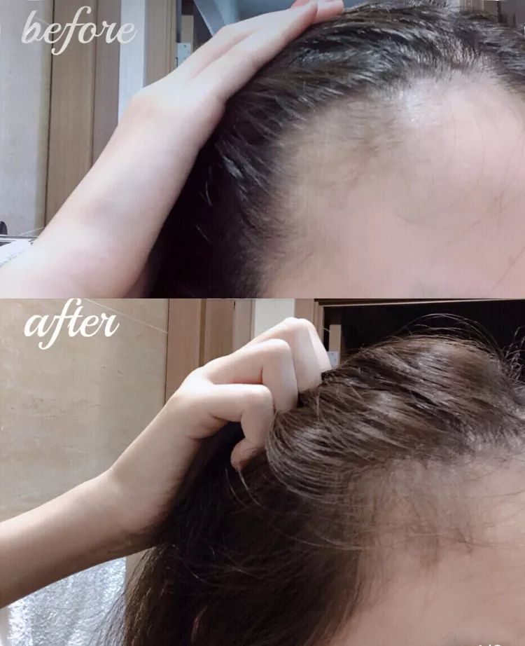 疯狂掉头发发际线后移,疯狂掉头发头发变得稀疏