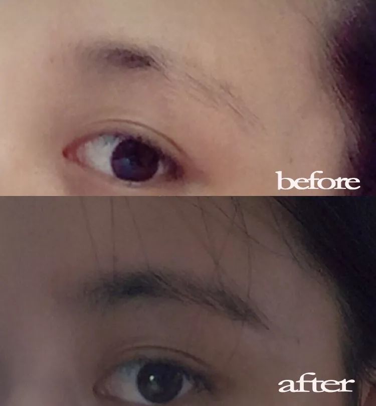 疯狂掉头发发际线后移,疯狂掉头发头发变得稀疏