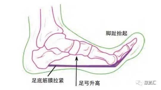 美国物理治疗协会发布足底筋膜炎权威康复指南：有效的康复训练方法一网打尽