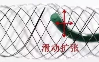 柳暗花明专栏｜栓塞颅内动脉瘤时微导管无法穿过LVIS支架网眼怎么办