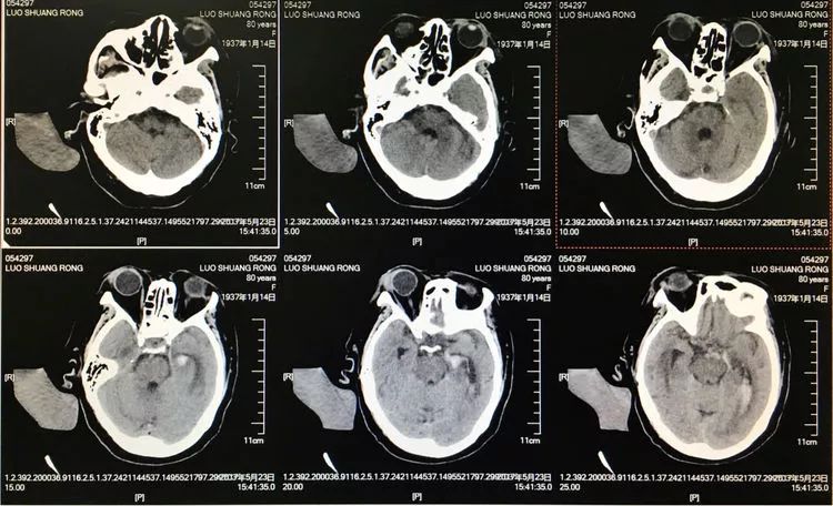 柳暗花明专栏｜栓塞颅内动脉瘤时微导管无法穿过LVIS支架网眼怎么办