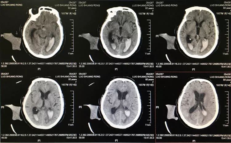 柳暗花明专栏｜栓塞颅内动脉瘤时微导管无法穿过LVIS支架网眼怎么办