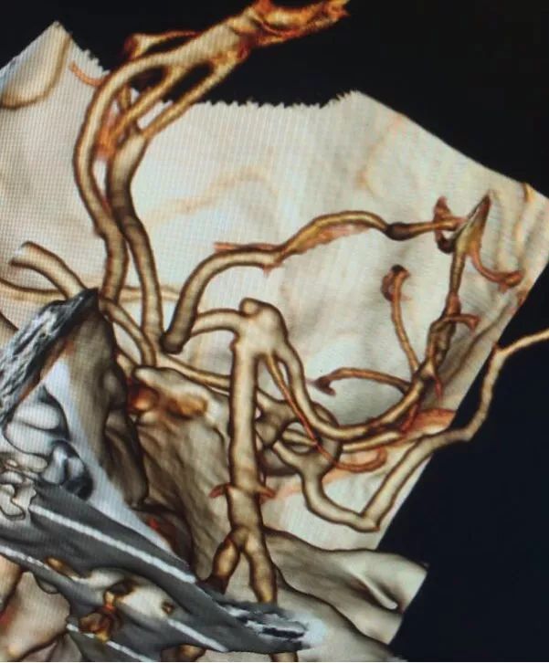 柳暗花明专栏｜栓塞颅内动脉瘤时微导管无法穿过LVIS支架网眼怎么办