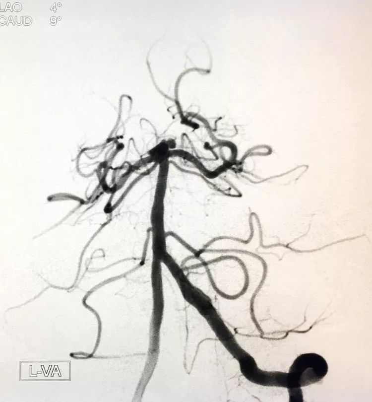 柳暗花明专栏｜栓塞颅内动脉瘤时微导管无法穿过LVIS支架网眼怎么办