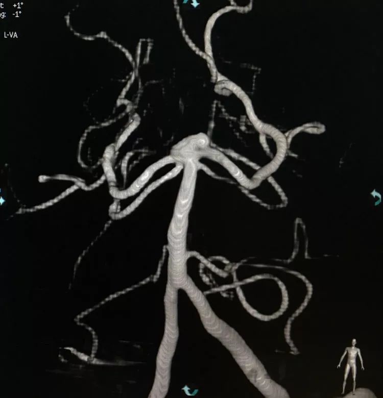柳暗花明专栏｜栓塞颅内动脉瘤时微导管无法穿过LVIS支架网眼怎么办