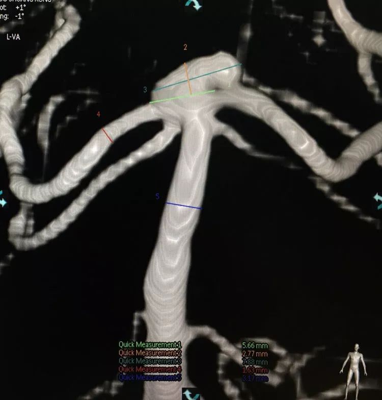 柳暗花明专栏｜栓塞颅内动脉瘤时微导管无法穿过LVIS支架网眼怎么办