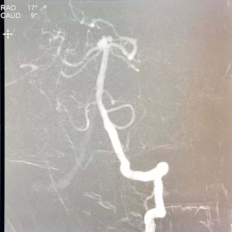 柳暗花明专栏｜栓塞颅内动脉瘤时微导管无法穿过LVIS支架网眼怎么办