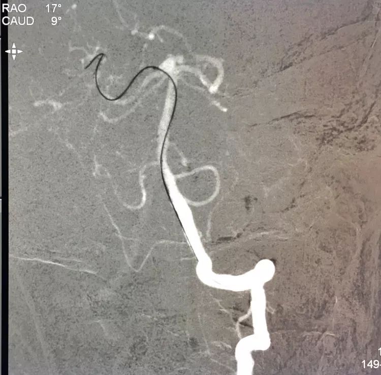 柳暗花明专栏｜栓塞颅内动脉瘤时微导管无法穿过LVIS支架网眼怎么办