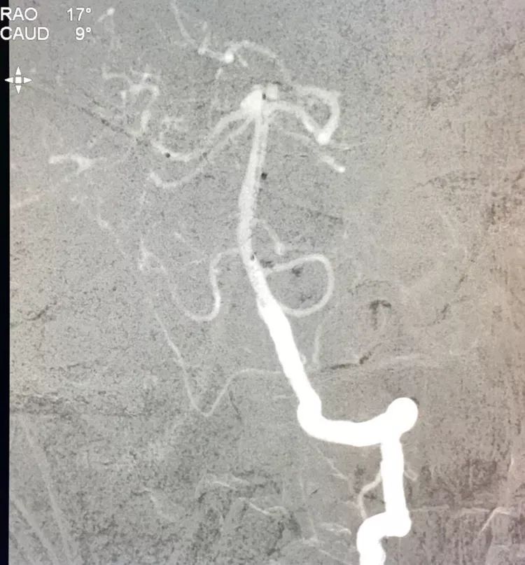 柳暗花明专栏｜栓塞颅内动脉瘤时微导管无法穿过LVIS支架网眼怎么办