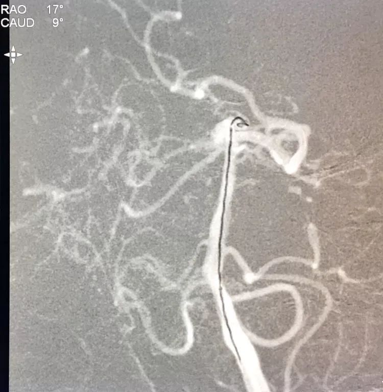 柳暗花明专栏｜栓塞颅内动脉瘤时微导管无法穿过LVIS支架网眼怎么办