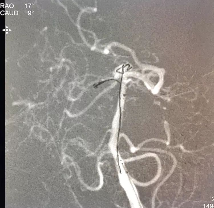 柳暗花明专栏｜栓塞颅内动脉瘤时微导管无法穿过LVIS支架网眼怎么办