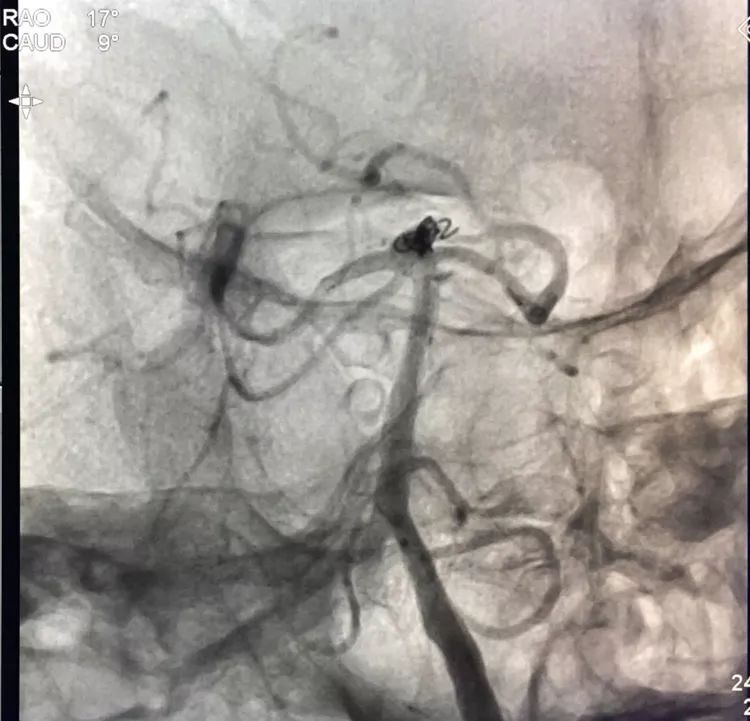 柳暗花明专栏｜栓塞颅内动脉瘤时微导管无法穿过LVIS支架网眼怎么办
