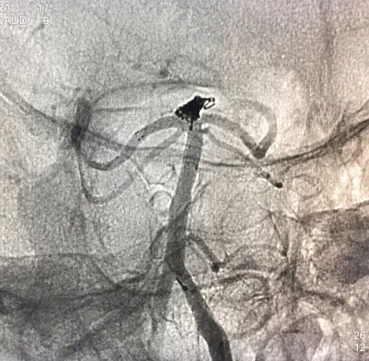 柳暗花明专栏｜栓塞颅内动脉瘤时微导管无法穿过LVIS支架网眼怎么办