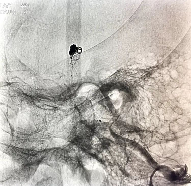 柳暗花明专栏｜栓塞颅内动脉瘤时微导管无法穿过LVIS支架网眼怎么办