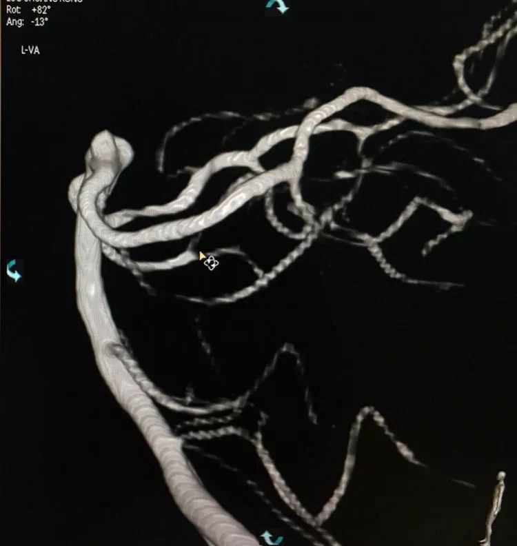 柳暗花明专栏｜栓塞颅内动脉瘤时微导管无法穿过LVIS支架网眼怎么办