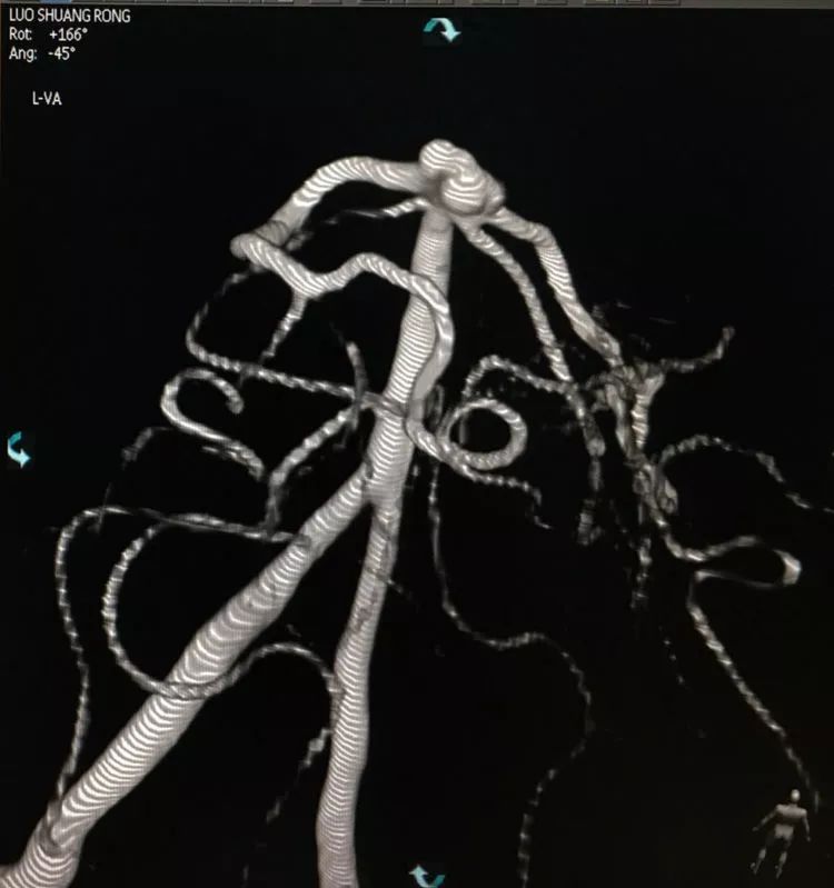 柳暗花明专栏｜栓塞颅内动脉瘤时微导管无法穿过LVIS支架网眼怎么办