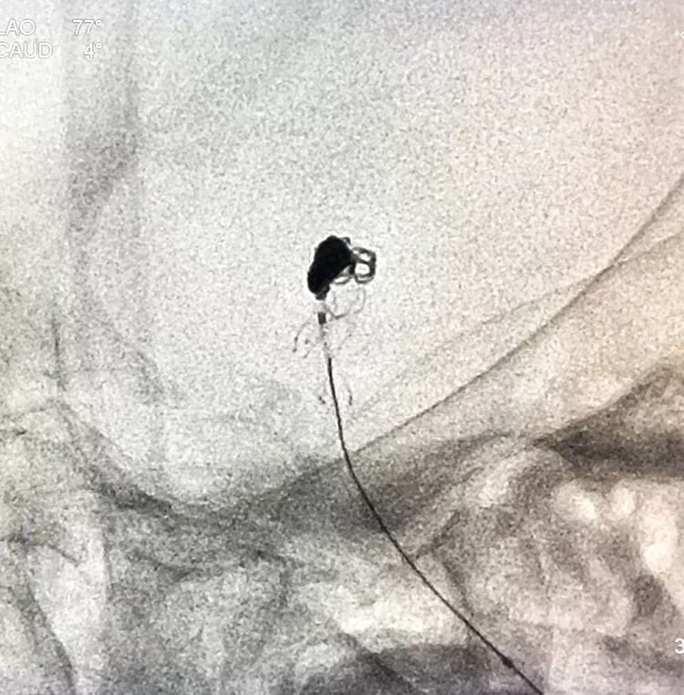 柳暗花明专栏｜栓塞颅内动脉瘤时微导管无法穿过LVIS支架网眼怎么办