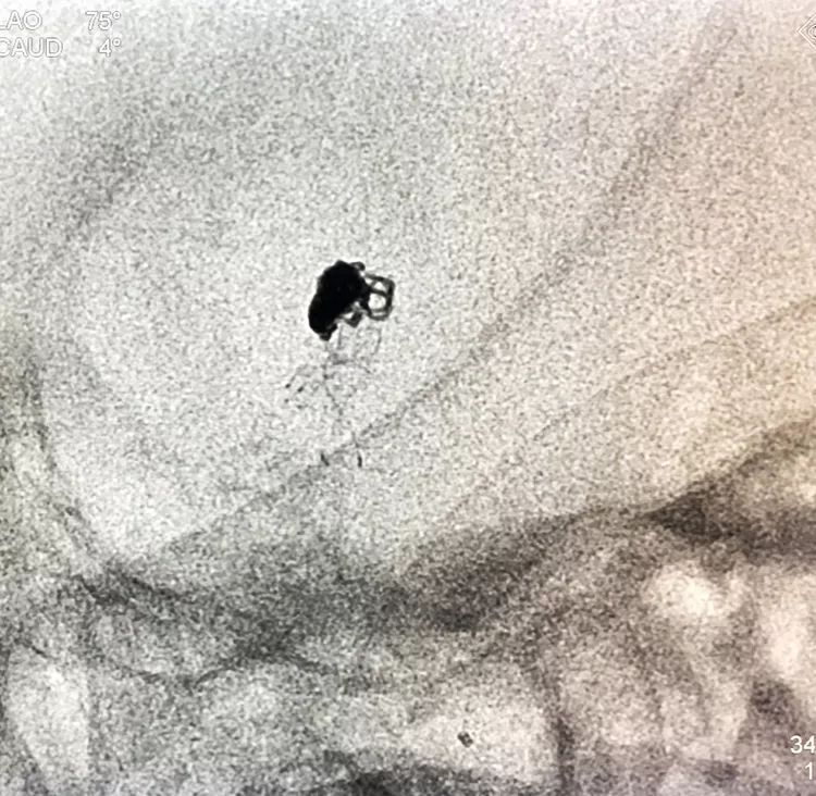 柳暗花明专栏｜栓塞颅内动脉瘤时微导管无法穿过LVIS支架网眼怎么办
