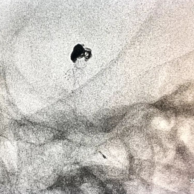 柳暗花明专栏｜栓塞颅内动脉瘤时微导管无法穿过LVIS支架网眼怎么办