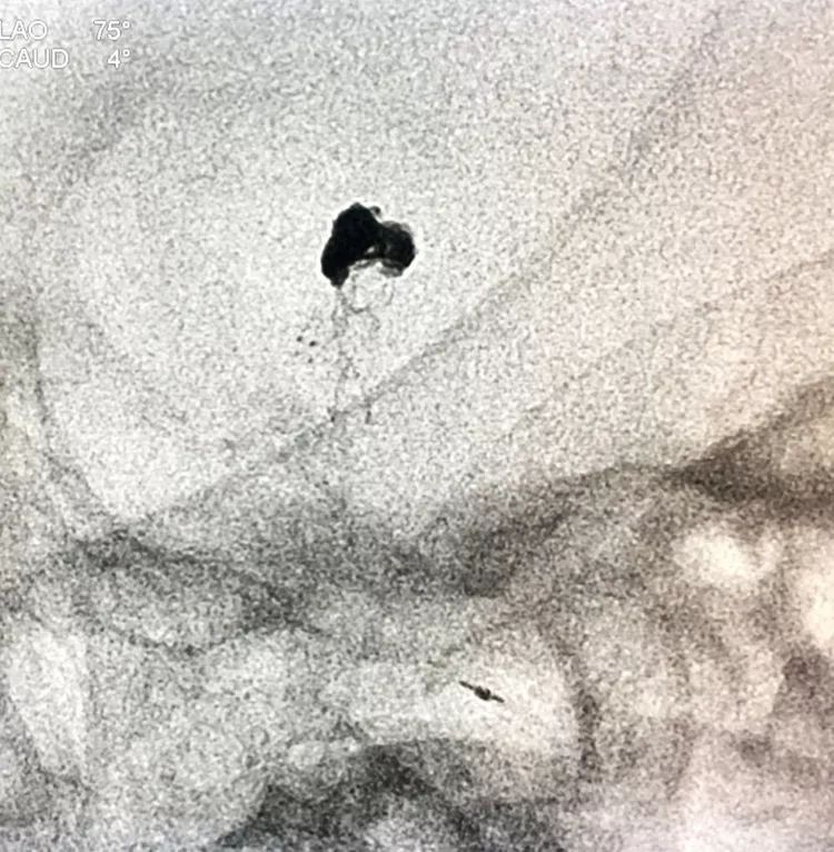 柳暗花明专栏｜栓塞颅内动脉瘤时微导管无法穿过LVIS支架网眼怎么办