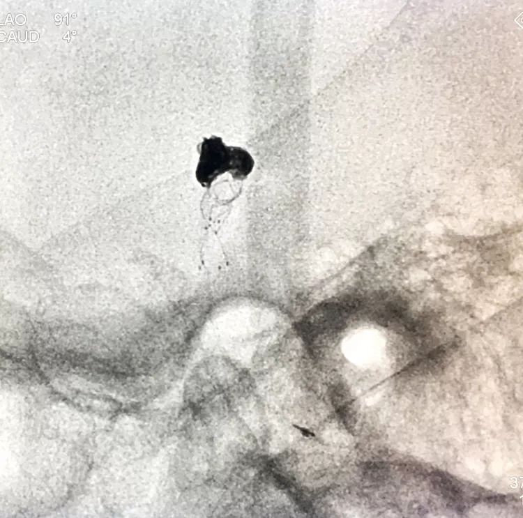 柳暗花明专栏｜栓塞颅内动脉瘤时微导管无法穿过LVIS支架网眼怎么办