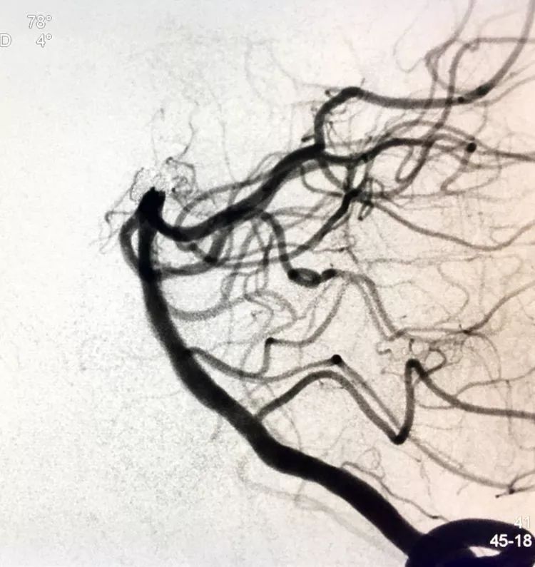 柳暗花明专栏｜栓塞颅内动脉瘤时微导管无法穿过LVIS支架网眼怎么办