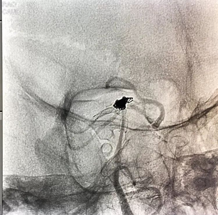 柳暗花明专栏｜栓塞颅内动脉瘤时微导管无法穿过LVIS支架网眼怎么办