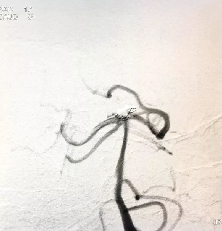柳暗花明专栏｜栓塞颅内动脉瘤时微导管无法穿过LVIS支架网眼怎么办