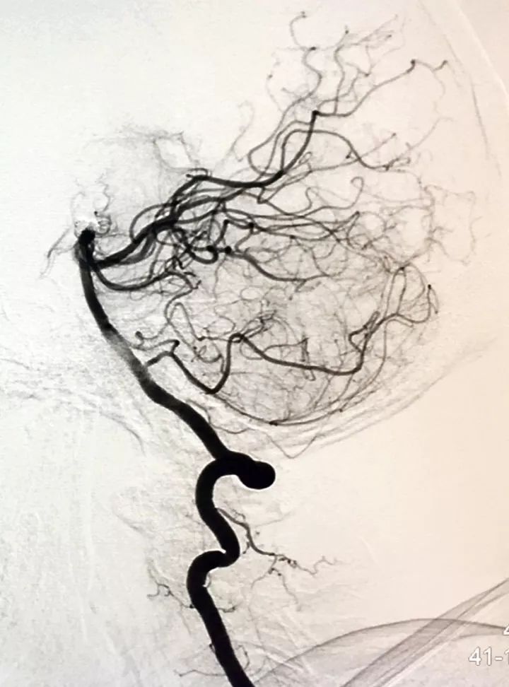 柳暗花明专栏｜栓塞颅内动脉瘤时微导管无法穿过LVIS支架网眼怎么办