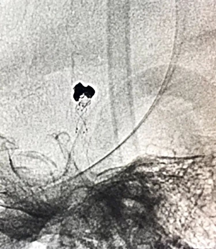 柳暗花明专栏｜栓塞颅内动脉瘤时微导管无法穿过LVIS支架网眼怎么办