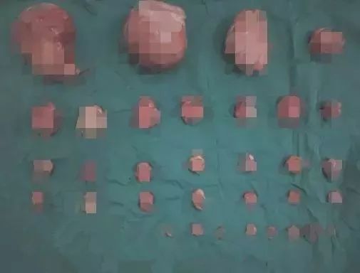 未婚女子形似怀孕7个月,医生发现她肚子里密密麻麻……