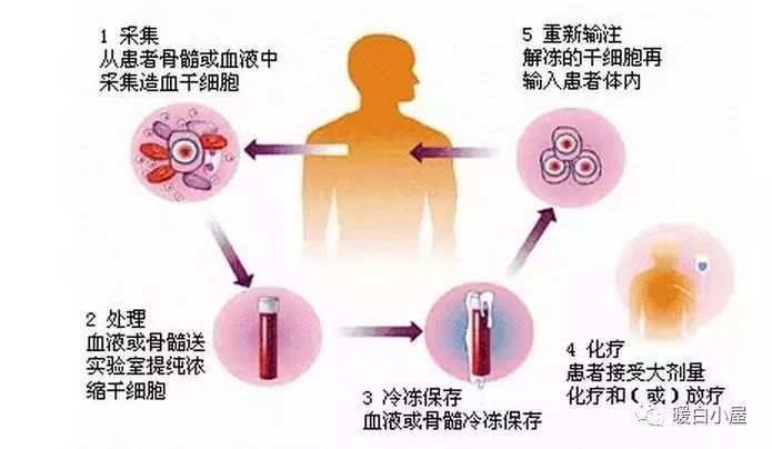 干细胞最全科普,造血干细胞移植后白细胞低原因