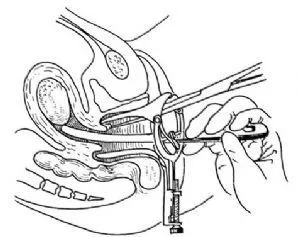 口服“他莫昔芬”子宫内膜增厚怎么办?