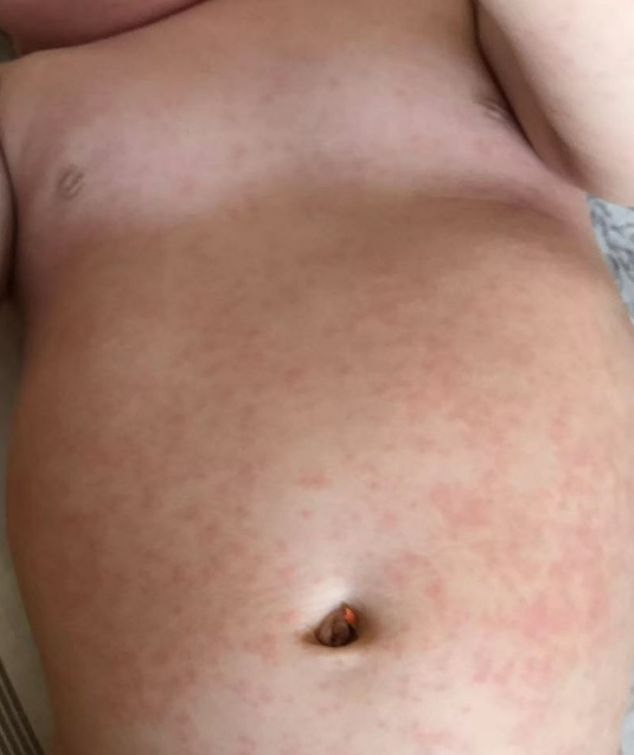 幼儿急疹几乎每个宝贝都逃不过,幼儿急疹每个孩子都出吗