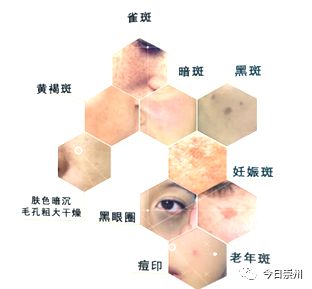 「崇州妇幼」神奇督脉灸——冬日里的健康火！