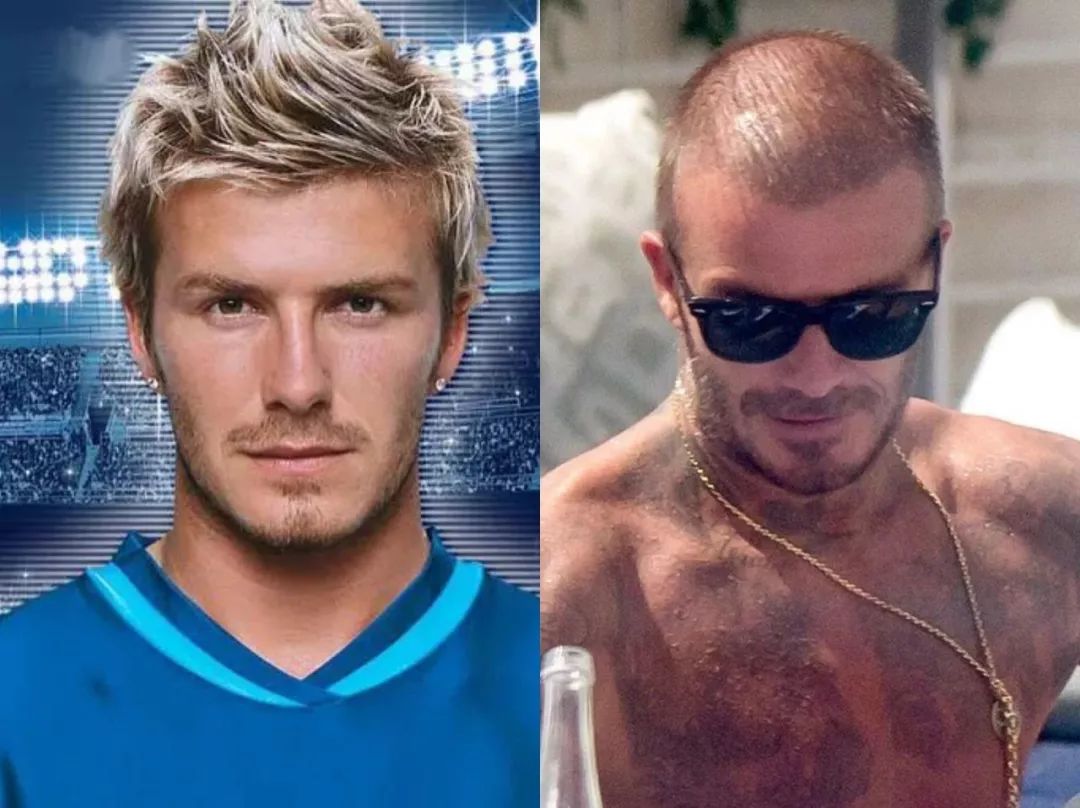 头秃拯救方式,头秃怎么拯救额头