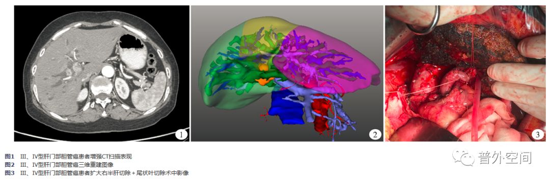 肝门部胆管癌转移到肝怎么治,肝门胆管癌根治性切除手术