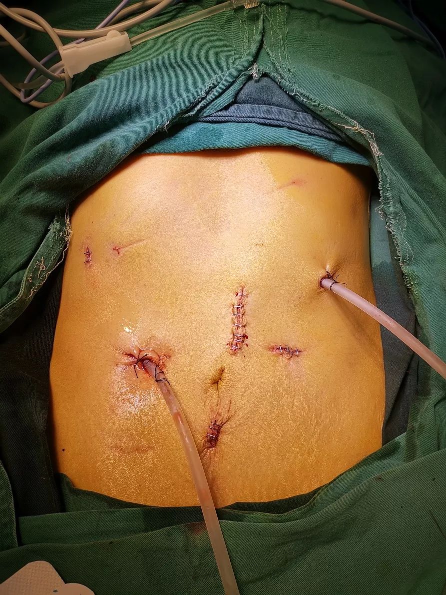 它被誉为普通外科手术“王冠上的明珠”，如今枣庄市立医院成功将明珠拿下！