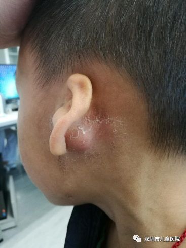 五岁孩子发烧感冒后脸上起小红点,5岁男孩发烧后耳朵里面红肿